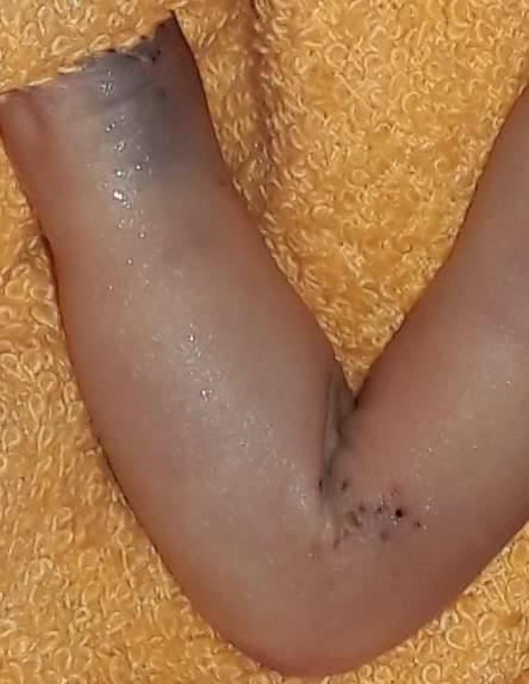 صورة يد الطفل بعد خروج جثته من المستشفى