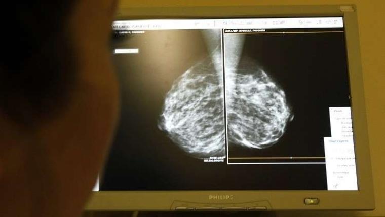 24 طفرة جينية مجهولة تزيد خطر الإصابة بسرطان الثدي
